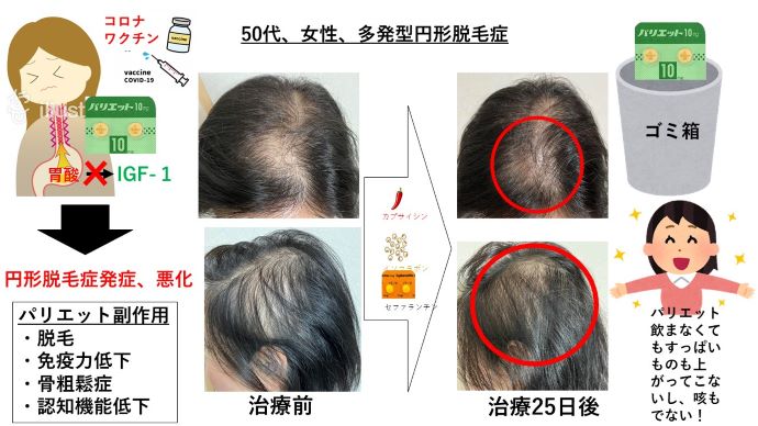 円形脱毛症　病院